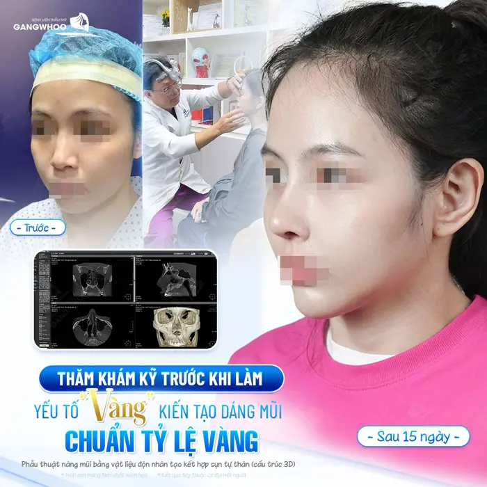 Thăm khám kỹ trước khi làm yếu tố vàng giúp kiến tạo dáng mũi đẹp chuẩn tỷ lệ 