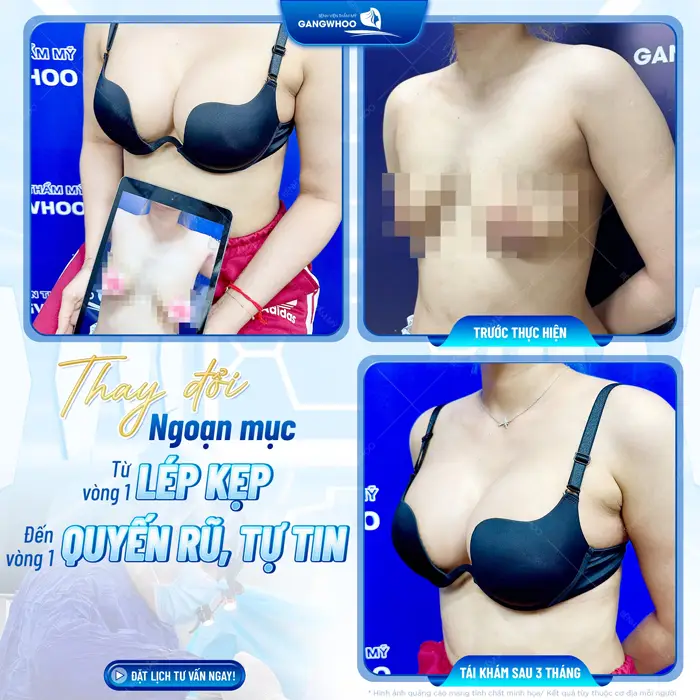 Thay đổi ngoạn mục từ vòng 1 lép kẹp đến vòng 1 căng tròn, quyến rũ và tự nhiên