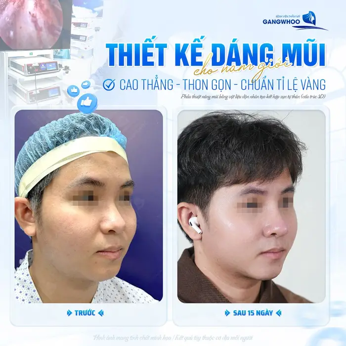 Thiết kế dáng mũi cho nam giới sau 15 ngày đã ổn định và chuẩn tỷ lệ với đường nét gương mặt