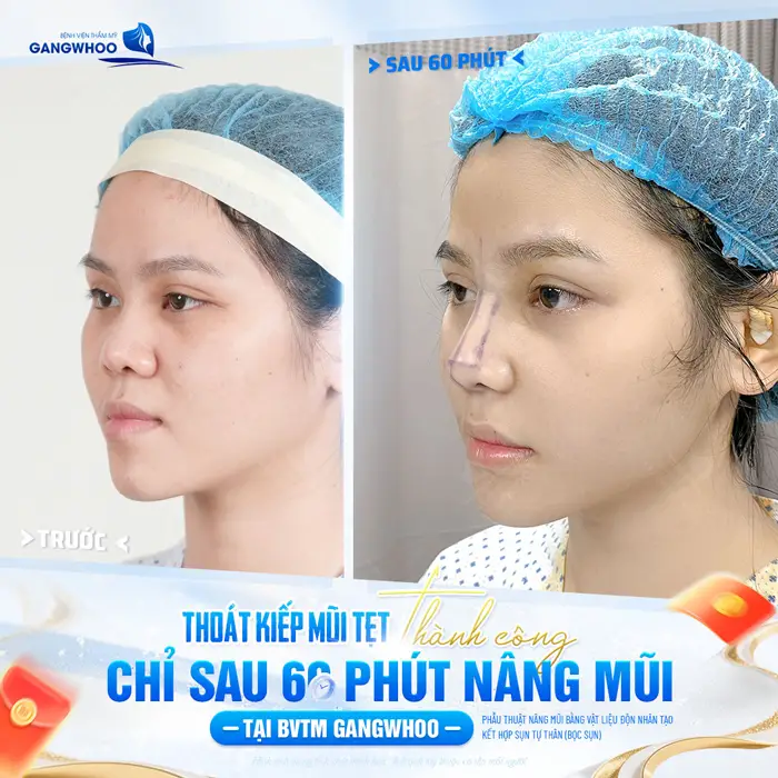 Nâng Mũi Bọc Sụn Được Bao Lâu? Cách Chăm Sóc Duy Trì Lâu Dài 2 Thoát kiếp mũi tẹt thành công chỉ sau 60 phút phẫu thuật nâng mũi tại BVTM Gangwhoo