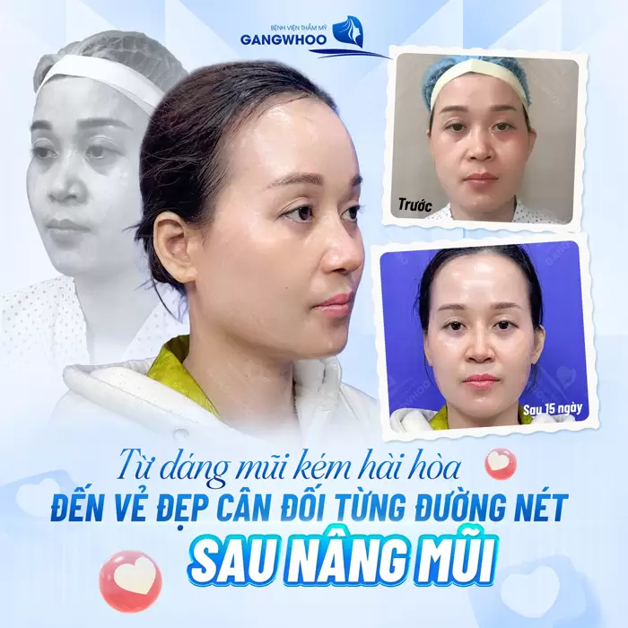 Từ dáng mũi kém hài hòa đến vẻ đẹp cân đối đẹp chuẩn từng đường nét sau nâng mũi ai nhìn cũng khen 