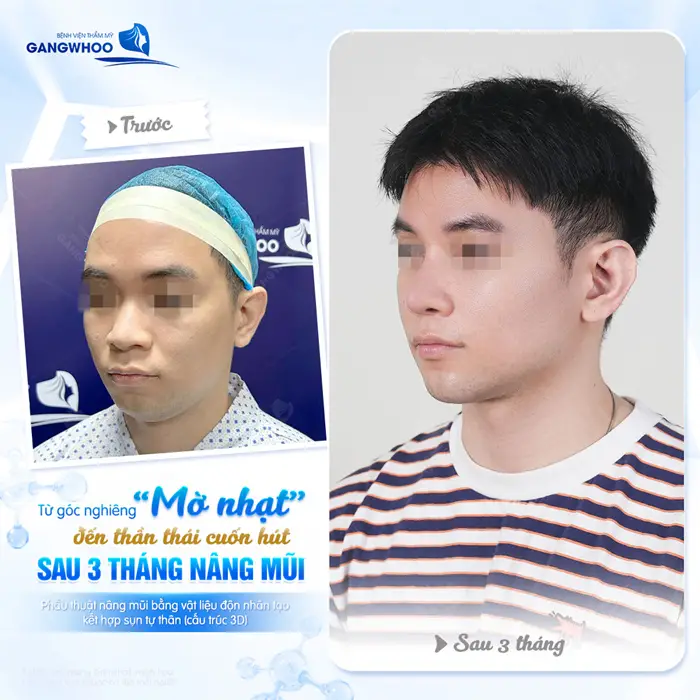 Sau 3 tháng nâng mũi từ nhan sắc mờ nhạt đến gương mặt có điểm nhấn