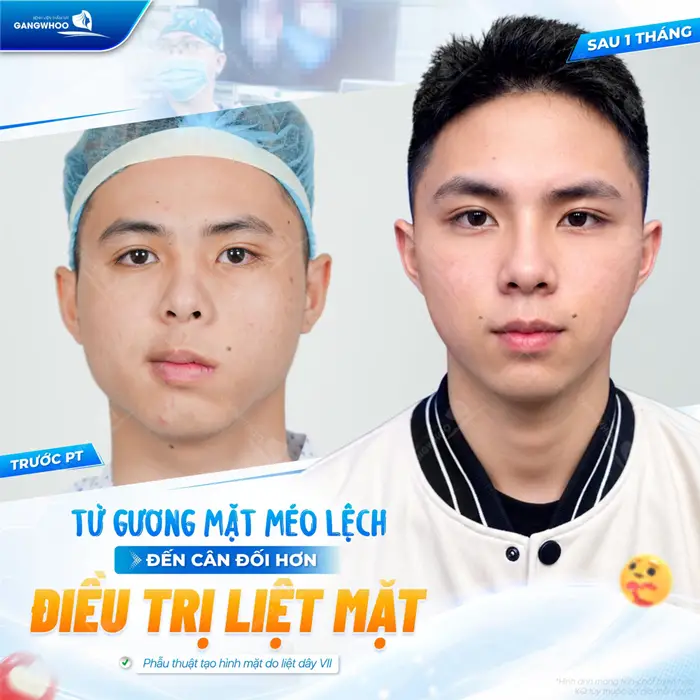 Từ gương mặt méo lệch đến gương mặt cân đối sau điều trị liệt mặt
