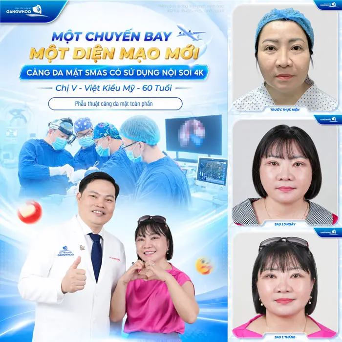 1 chuyến bay 1 diện mạo sau căng da mặt Smas có sử dụng nội soi 4K tự tin hơn với diện mạo của chính mình