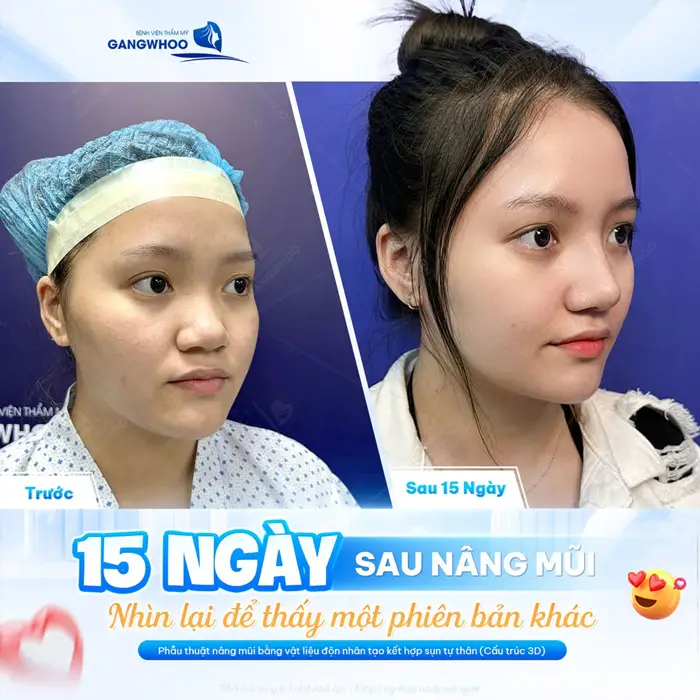 9 Cách Giảm Sưng Sau Nâng Mũi Nhanh Hiệu Quả 1 15 ngày sau nâng mũi nhin lại thấy 1 phiên bản khác xinh đẹp hơn, rạng rỡ hơn và tự tin hơn