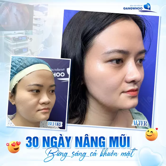 Bừng sáng cả khuôn mặt chỉ sau 30 ngày nâng mũi nhan sắc đẹp thăng hạng