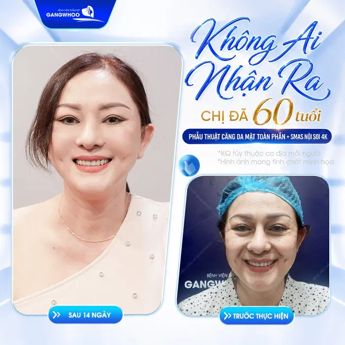 Không ai nhận ra U60 sau phẫu thuật căng da mặt toàn phần Smas nội soi 4K