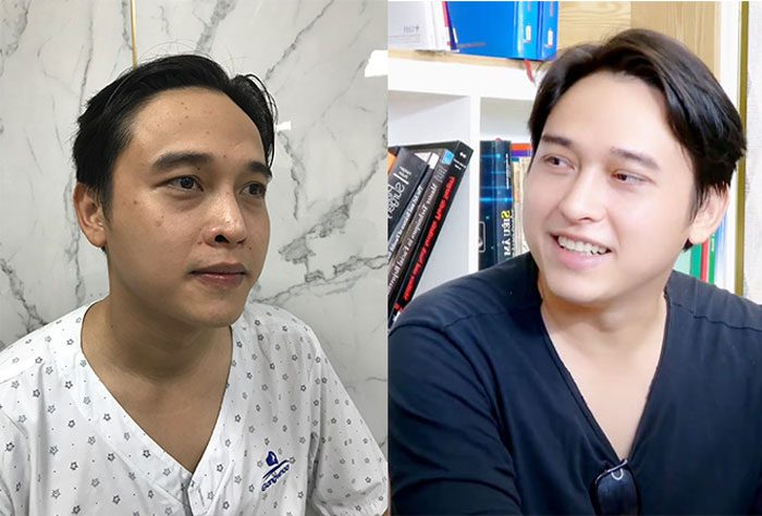 Actor Au Thanh Cat before & after beauty makeover at Gangwhoo Cosmetic Hospital
