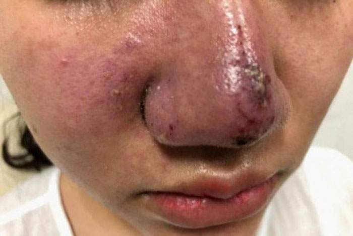 Infection after rhinoplasty