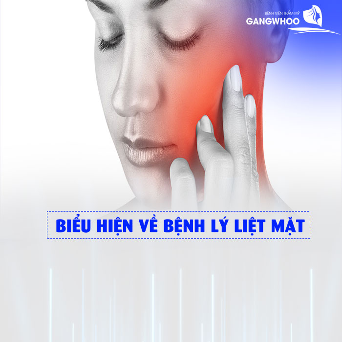 4 Cách Phòng Tránh Liệt Dây Thần Kinh Số 7 Hiệu Quả 2 bieu hien cua liet mat
