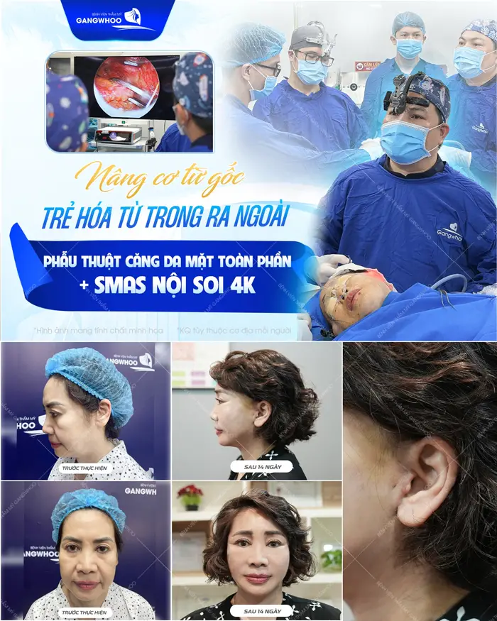 Nâng cơ từ gốc trẻ hóa từ trong ra ngoài với phương pháp phẫu thuật căng da mặt toàn phần Smas nội soi 4K