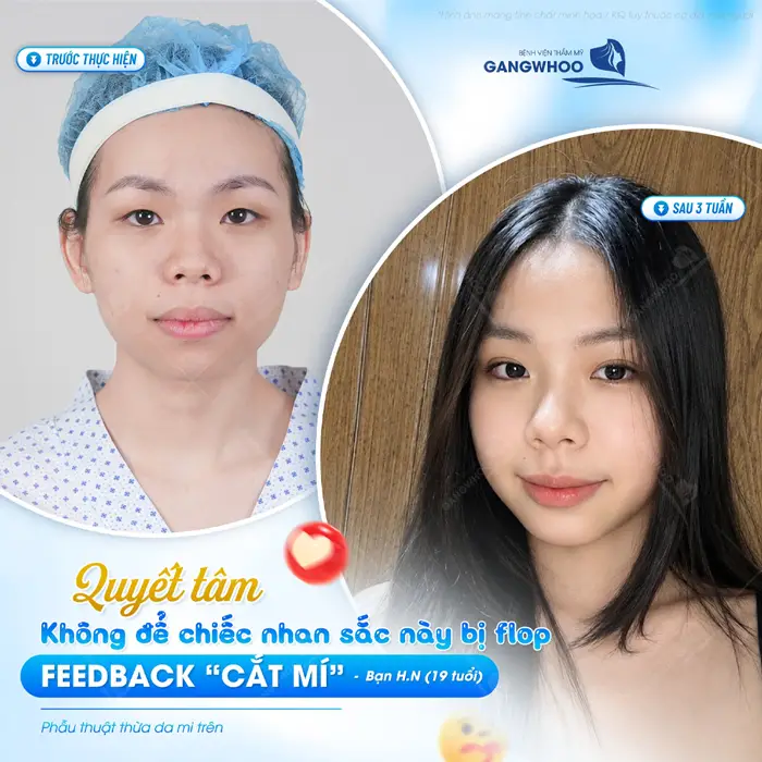 Nếp mí vào form đẹp xuất sắc feedback của khách hàng quá ưng diện mạo và nhan sắc mới này