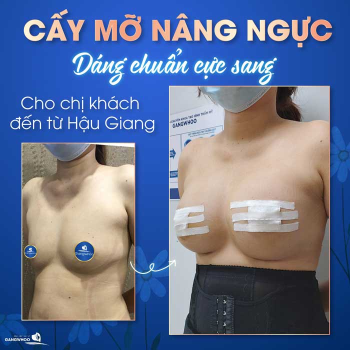 cay mo nang nguc 1