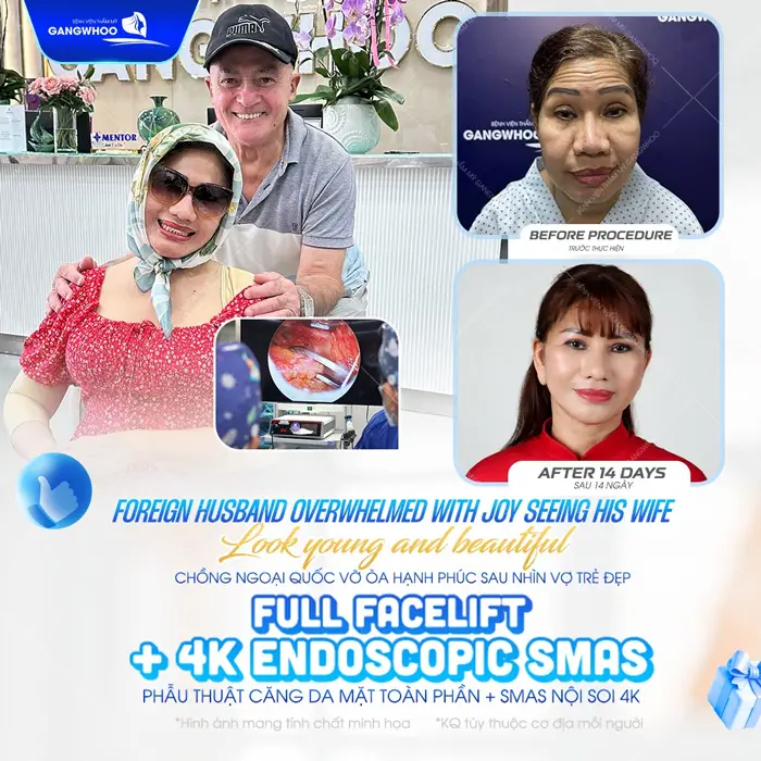Phẫu thuật căng da mặt toàn phần Smas nội soi 4K diện mạo trẻ hóa an toàn và hiệu quả ngay sau 14 ngày đã hoàn toàn khác biệt