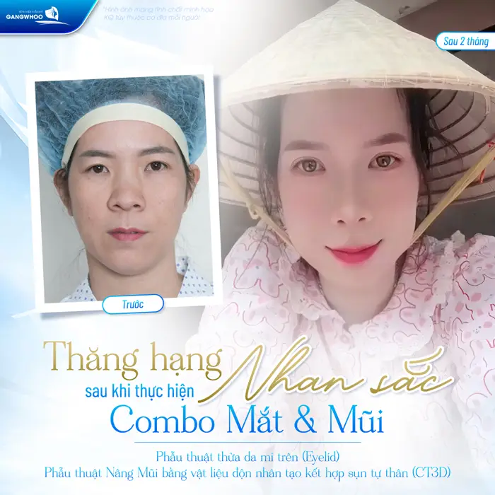 Thăng hạng nhan sắc, diện mạo thay đổi rõ nét sau nâng mũi và cắt mí
