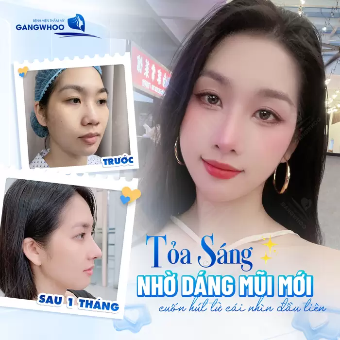 Dáng mũi cao đẹp hài hòa sau 1 tháng nâng mũi tại bệnh viện thẩm mỹ Gangwhoo 