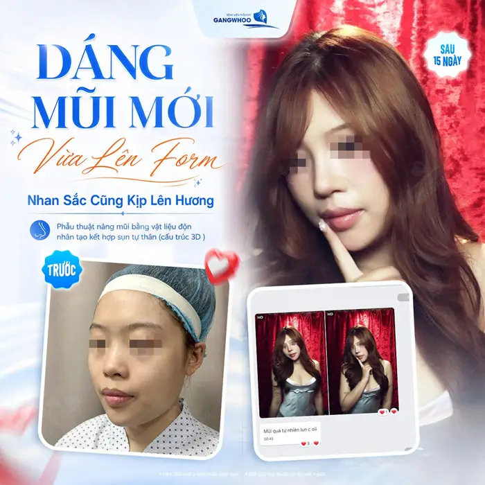 Nâng Mũi Bao Lâu Thì Lành? Cách Chăm Sóc Nhanh Lành 6 Dáng mũi mới vừa lên form nhan sắc cũng kịp lên hương đẹp chẩun diện mạo cho gương mặt thêm bừng sức sống
