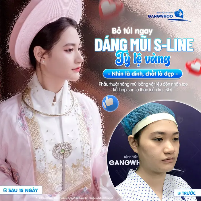 Dáng mũi S Line đẹp chuẩn tỷ lệ vàng nhìn là dính, chốt là đẹp kết quả thay đổi hoàn toàn khác biệt sau 15 ngày 