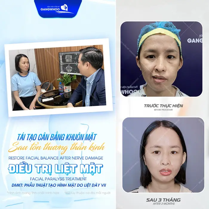 Tái tạo cân bằng khuôn mặt sau tổn thương thần kinh 3 tháng gương mặt đã cân đối và hài hào thấy rõ