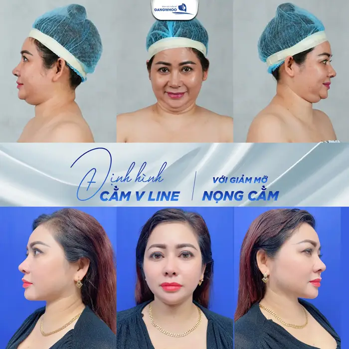 Hút Mỡ Nọng Cằm Có Nguy Hiểm Không? Bác Sĩ Giải Đáp 3 Hút Mỡ Nọng Cằm Có Nguy Hiểm Không? Bác Sĩ Giải Đáp
