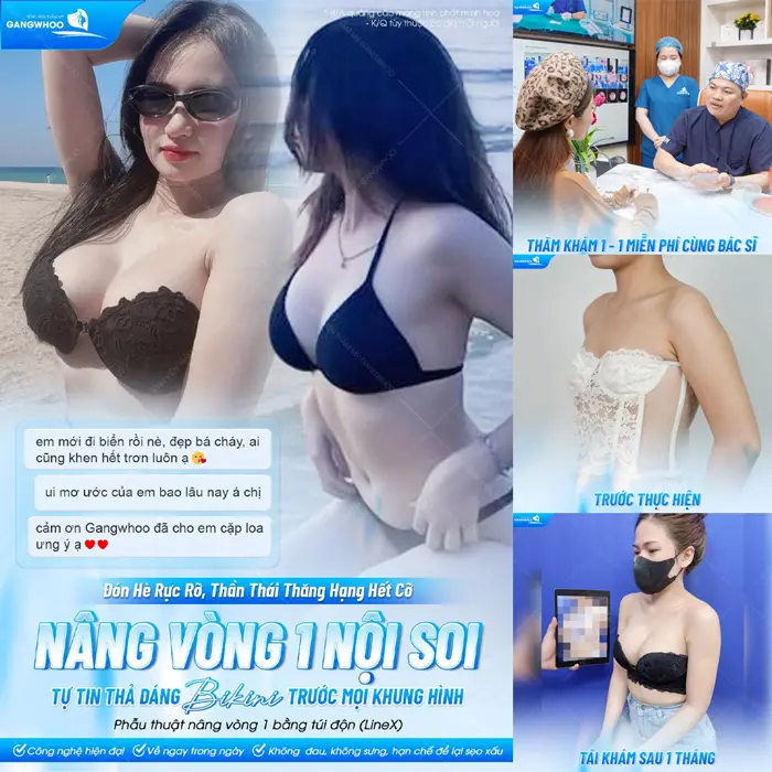 Phẫu Thuật Nội Soi Nâng Ngực (Nâng Ngực Line X) – Vòng 1 Gợi Cảm Chuẩn Tỉ Lệ Vàng 4 Nâng vòng 1 nội soi tự tin thả dáng với Bikini cực cháy trước mọi khung hình