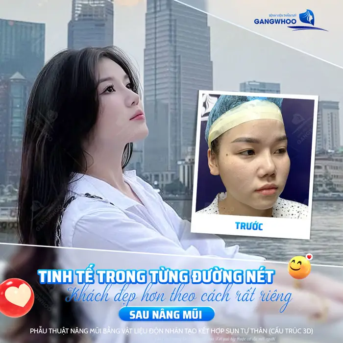 Nâng Mũi Bọc Sụn Giá Bao Nhiêu? Bảng Giá Mới Nhất 2026 2 Sau nâng mũi nét đẹp tinh tế trong từng đường nét vẻ đẹp riêng vừa ấn tượng vừa thu hút