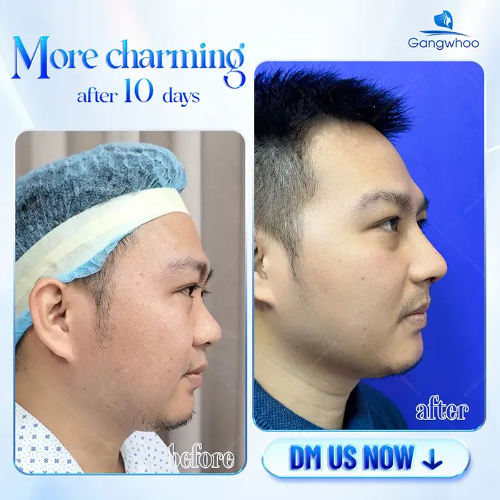 Male Rhinoplasty – The Perfect Masculine Nose – The Ideal Handsome Look 2 en nang mui cho nam 1