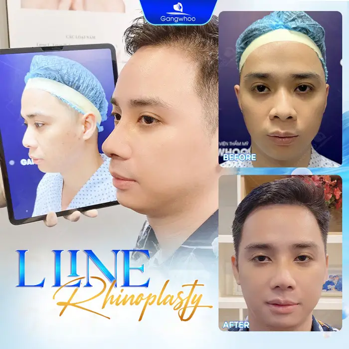 Male Rhinoplasty – The Perfect Masculine Nose – The Ideal Handsome Look 3 en nang mui cho nam 2