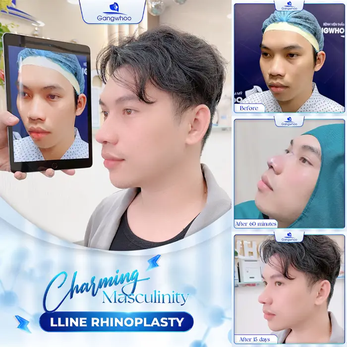 Male Rhinoplasty – The Perfect Masculine Nose – The Ideal Handsome Look 4 en nang mui cho nam 3