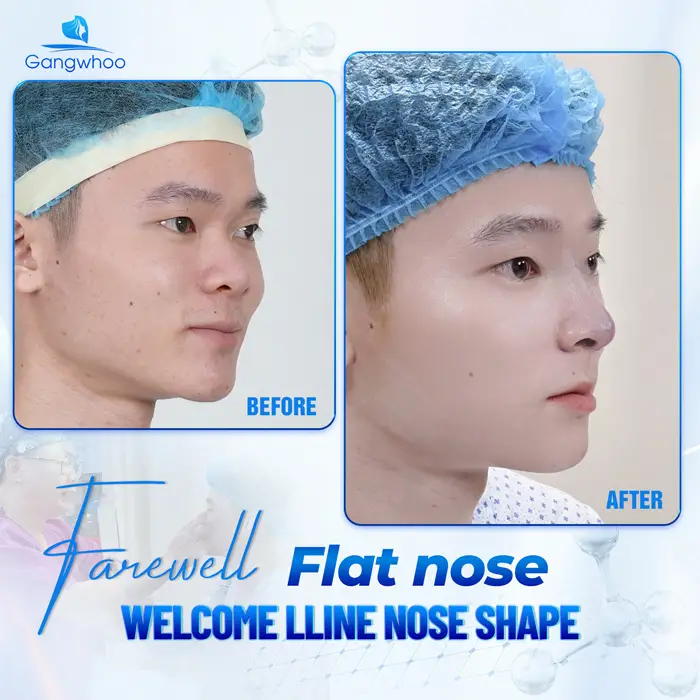 Male Rhinoplasty – The Perfect Masculine Nose – The Ideal Handsome Look 5 en nang mui cho nam 4