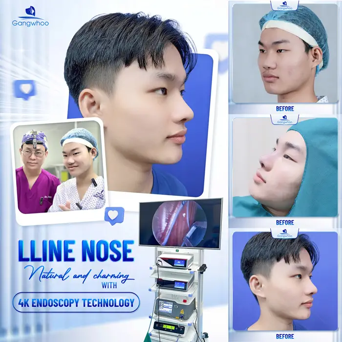 Male Rhinoplasty – The Perfect Masculine Nose – The Ideal Handsome Look 1 en nang mui cho nam 5