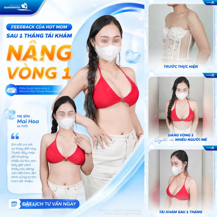Nâng Ngực Qua Đường Rốn Là Gì? Có An Toàn Không? 1 Sau 1 tháng tái khám san nâng vòng 1 mẹ bỉm tự tin rạng rỡ thả dáng siêu slay sau phẫu thuật