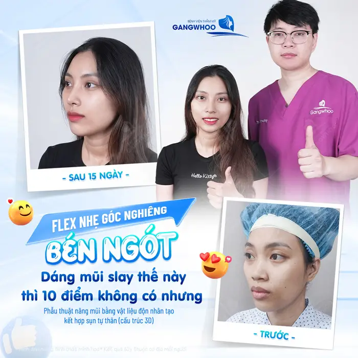 Dáng mũi đẹp Slay đẹp chuẩn 10 điểm không có nhưng sau 15 ngày phẫu thuật nhan sắc đã thăng hạng thấy rõ