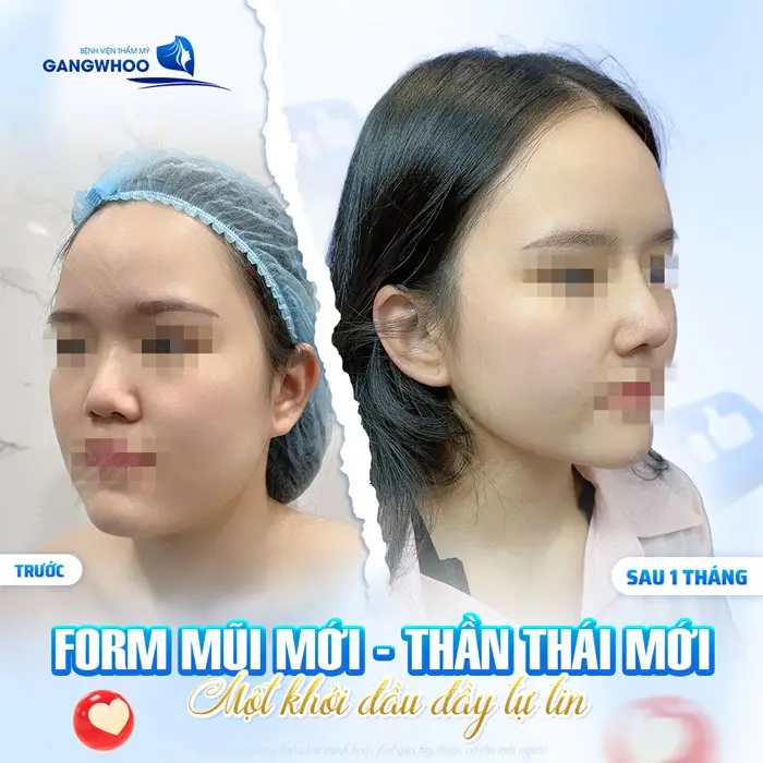 Form mũi mới thần thái mới tôn tạo nét đẹp hài hòa cho đường nét khuôn mặt