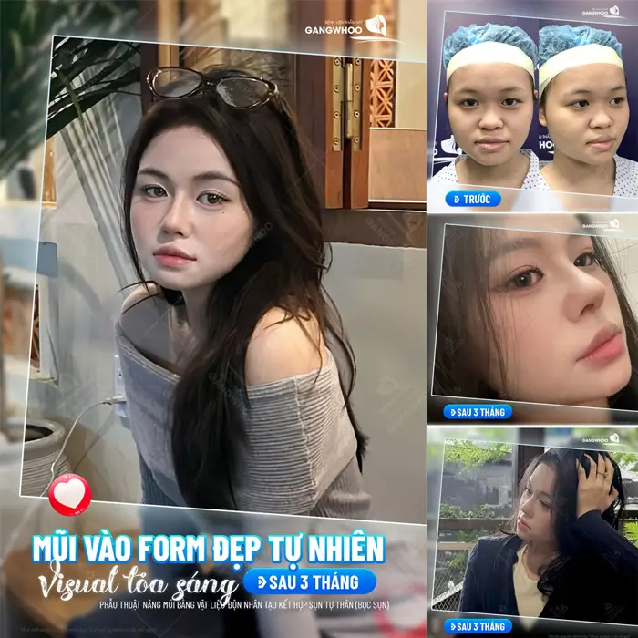 Nâng Mũi Bọc Sụn Giá Bao Nhiêu? Bảng Giá Mới Nhất 2026 16 Mũi vào form đẹp tự nhiên nhan sắc thăng hạng đầy cuốn hút