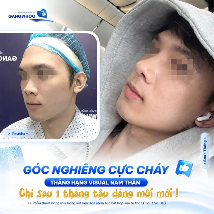 Góc ghiêng thăng hạng diện mạo chuẩn nhan sắc nam thần chỉ sau 1 tháng trùng tu dáng mũi