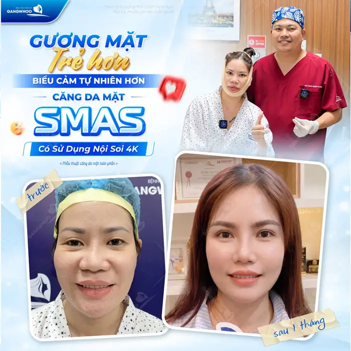 Gương mặt trẻ hơn biểu cảm tự nhiên hơn sau căng da mặt Smas có sử dụng hệ thống nội soi 4K