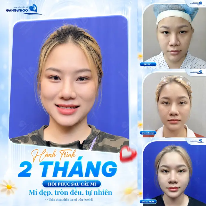 Bảng Giá Cắt Mí Bấm Mí Mắt Bao Nhiêu Tiền? Mới Năm 2026 5 Hành trình 2 thang hồi phục sau cắt mí tự tin hơn với nếp mí tròn đẹp, tự nhiên với nhan sắc ngày càng rạng rỡ
