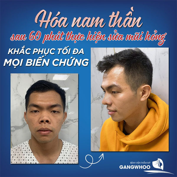 Deformed nose treatment at Gangwhoo Cosmetic Hospital