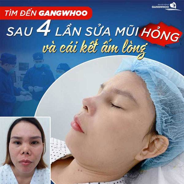 Nose revision at Gangwhoo Cosmetic Hospital