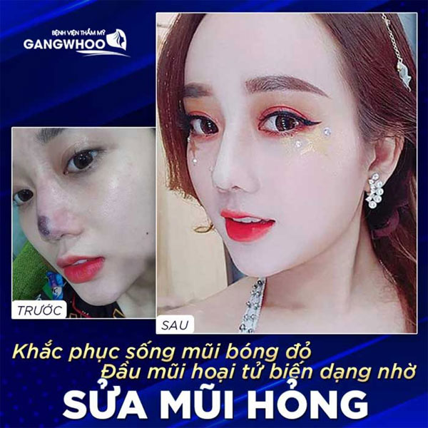 Review Sửa Mũi Hỏng, Nâng Mũi Bác Sĩ Phùng Mạnh Cường