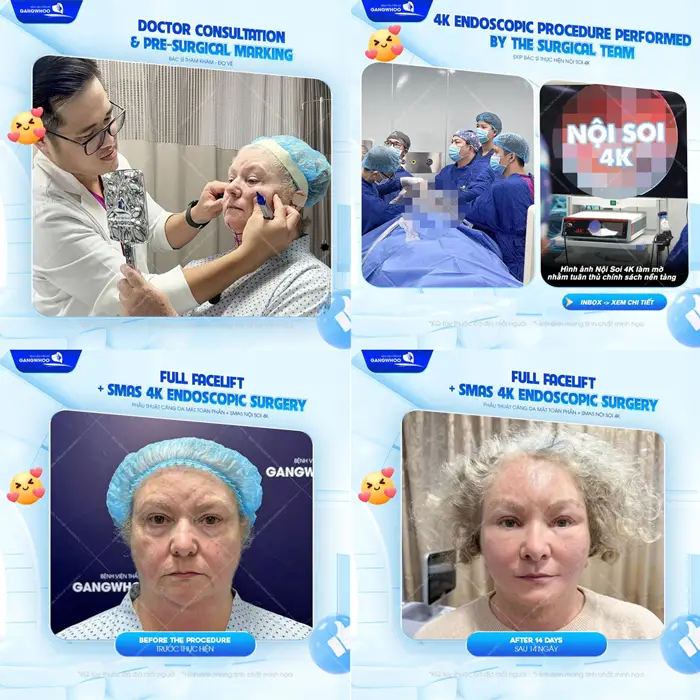 Kết quả sau căng da mặt tại BVTM Gangwhoo khách hàng quốc tế hài lòng về màn lột xác đẹp vượt ngoài mong đợi