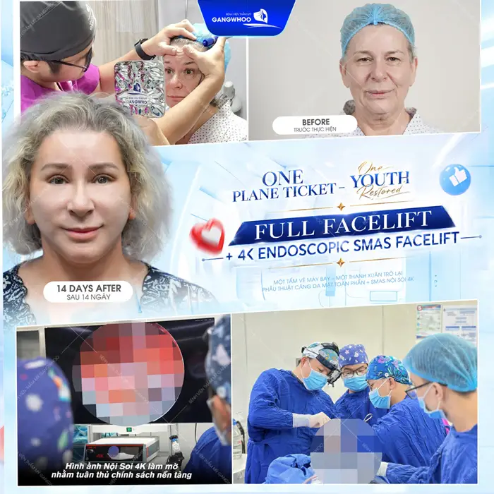 Diện mạo trẻ đẹp gương mặt thêm trẻ trung sau 1 lần thực hiện căng da mặt toàn phần Smas nội soi 4K
