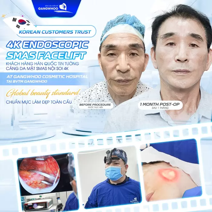 Căng Da Mặt Giá Bao Nhiêu? Bảng Giá Căng Da Mặt 2025 1 Căng da mặt trẻ hóa diện mạo chạm tới ước mở trẻ đẹp như mơ ước