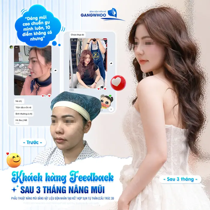 Nâng Mũi Có Được Vĩnh Viễn Không? Yếu Tố Ảnh Hưởng Độ Bền 3 Khách hàng Feedback sau 3 thang nâng mũi nhan sắc cực phẩm hóa nâng thơ xinh đẹp và thu hút