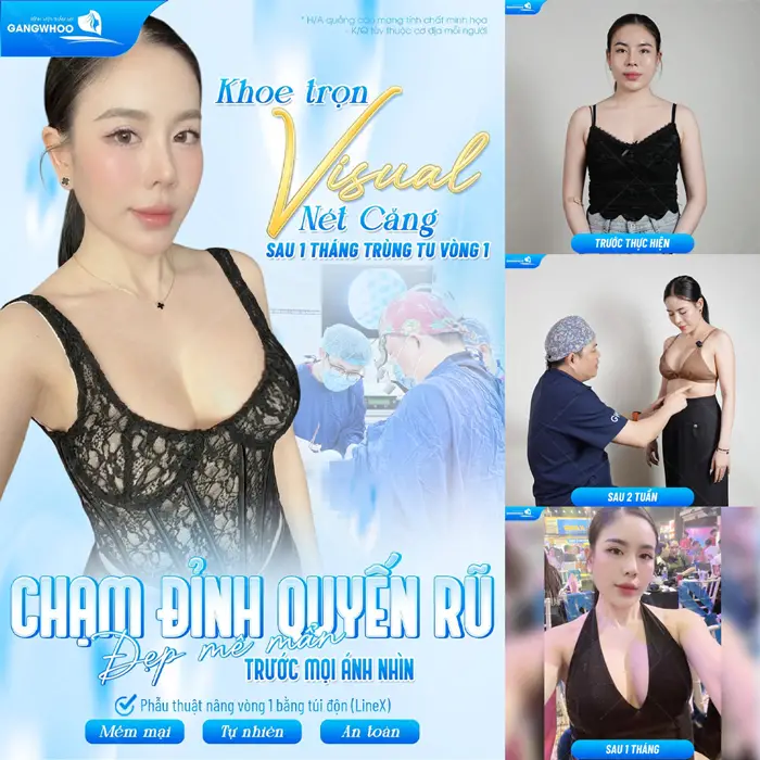 Phẫu Thuật Nội Soi Nâng Ngực (Nâng Ngực Ergonomix) - Ngực Đẹp Mềm Mại Thêm Căng Tròn 1 Khoe trọn Visual đẹp nét căng sau 1 tháng trùng tu vòng 1 sắc vóc chạm đỉnh quyến rũ