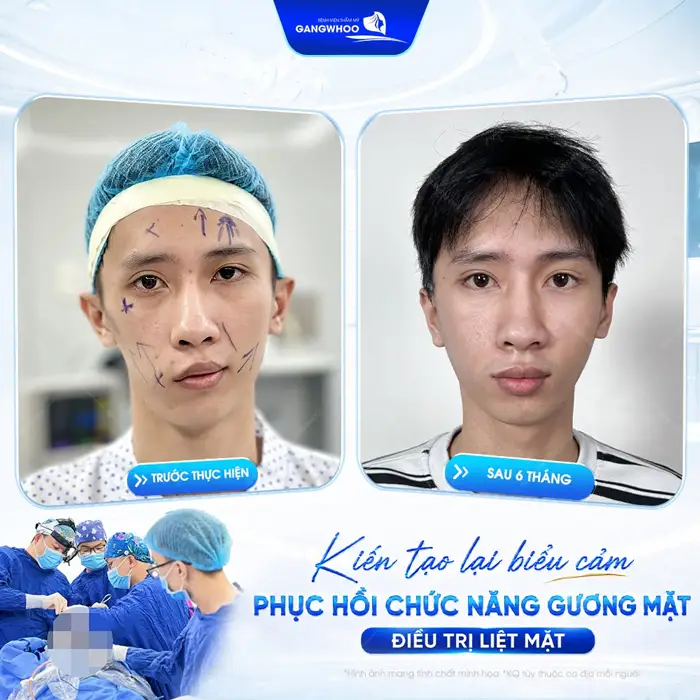 4 Phác Đồ Điều Trị Liệt Mặt Ngoại Biên Chuẩn Y Khoa 2 Kiến tạo lại biểu cảm phục hồi chức năng cho gương mạt sau 6 tháng gương mặt đã cân đối trở lại