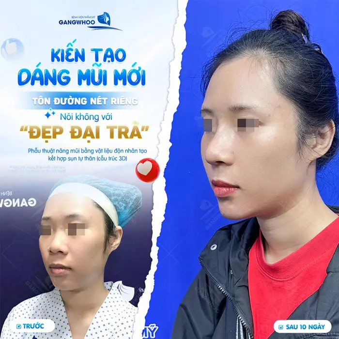 Kiến tạo dáng mũi mới tôn lên đường nét riêng cho khuôn mặt với vẻ đẹp riêng không bị đại trà