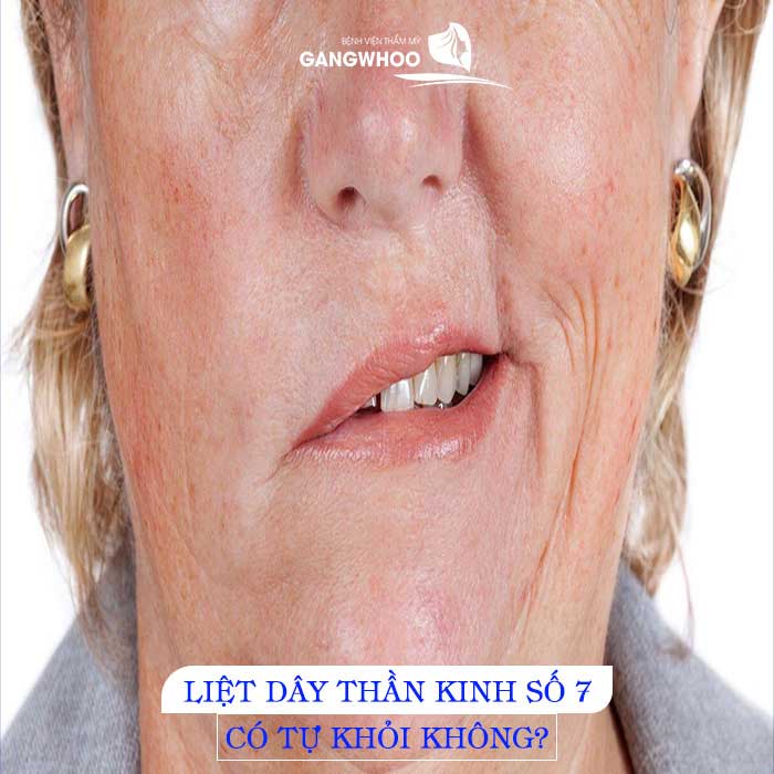 Liệt Dây Thần Kinh Số 7 Có Tự Khỏi Không? Bác Sĩ Giải Đáp 1 liet day than kinh co tu khoi khong