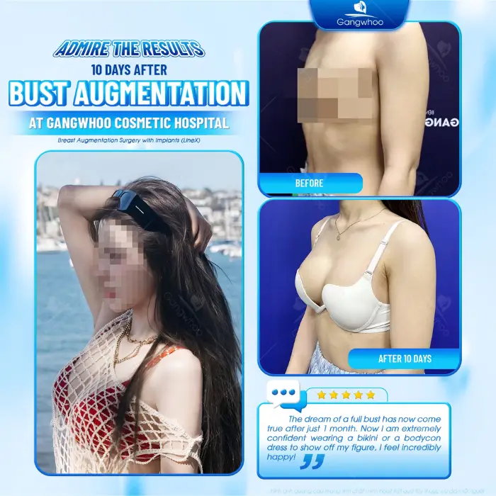 line x breast augmentation